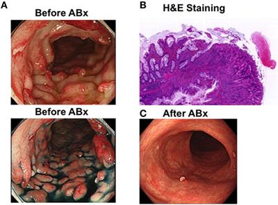 Dysbiosis-Associated Polyposis of the Colon—Cap Polyposis